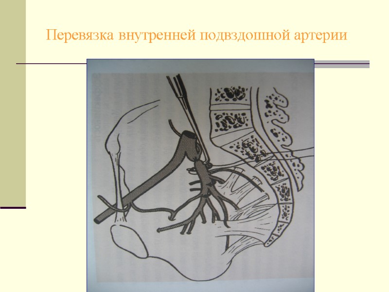 Перевязка внутренней подвздошной артерии